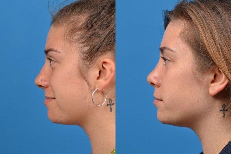 Rhinoplasty Photos Melbourne, FL Patient 30576